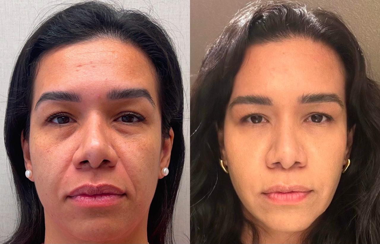 Harmonização Facial