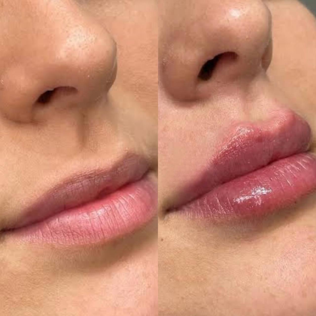 Harmonização Labial