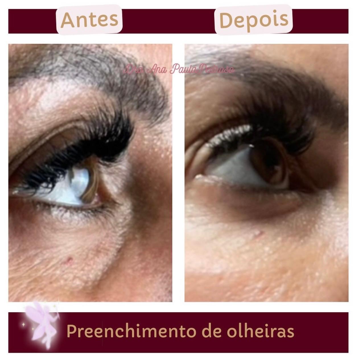 Preenchimento de Olheiras